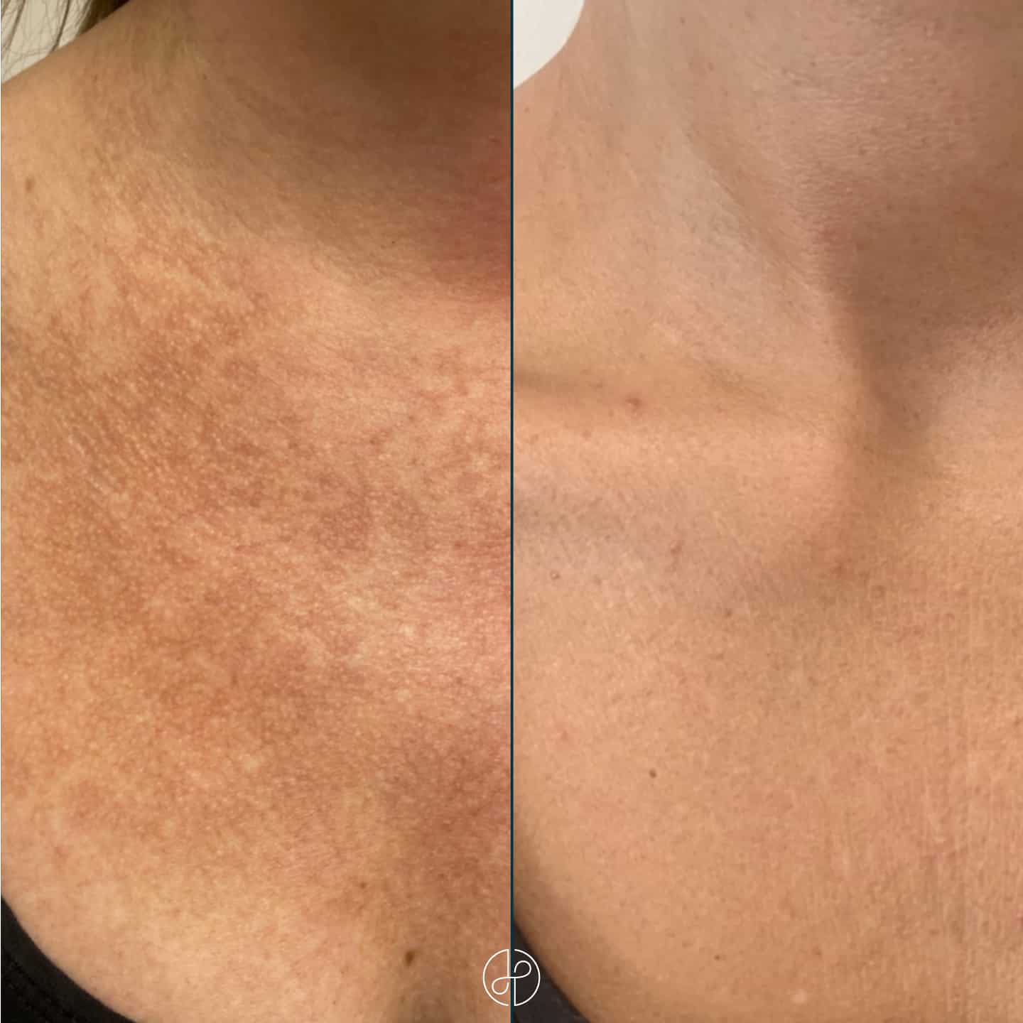 rejuvenation hudforyngende laser