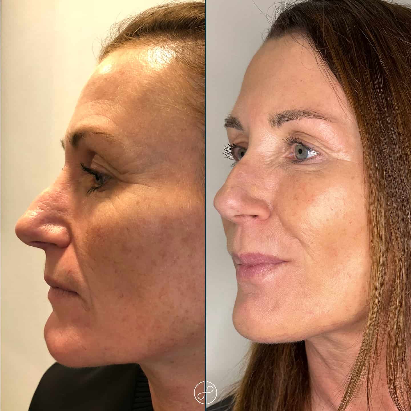 rejuvenation hudforyngende laser